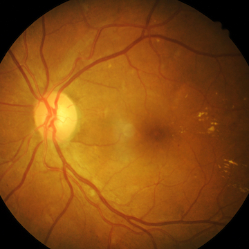 Retinal photography