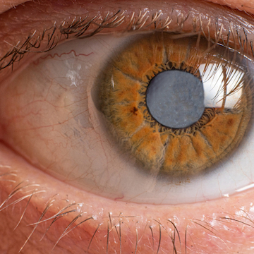 Pre- and post-op cataract assessments