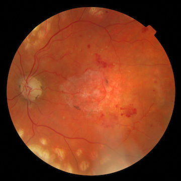 Glaucoma, diabetes and AMD screening