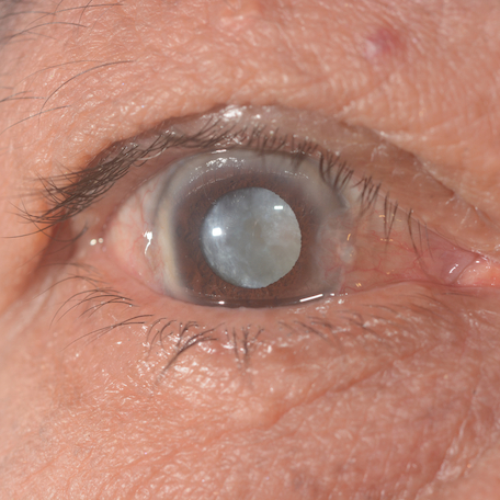 The facts about cataracts